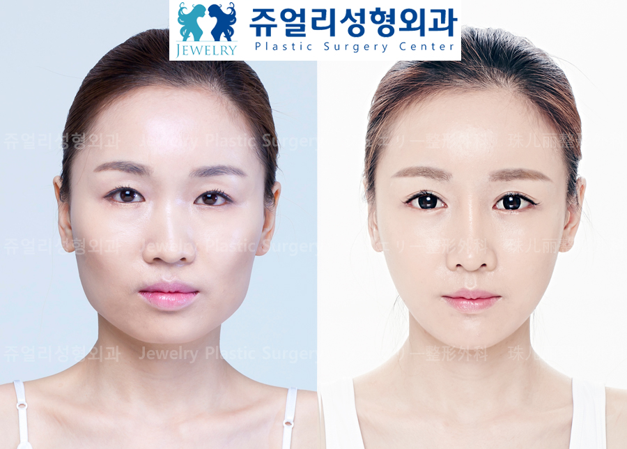 Eyes Surgery+Nose Surgery+Fat Grafting+Square Jaw Reduction+T-osteotomy+Cheekbone Reduction